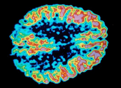 Image: Positron emission tomography (PET) scans of the brain of a patient with Alzheimer's disease [senile dementia] (photo courtesy US Department of Energy).